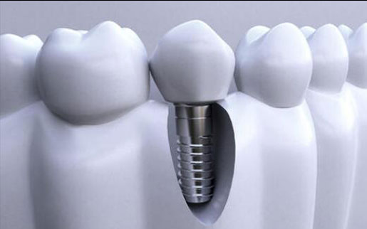 What is Immediate implant？