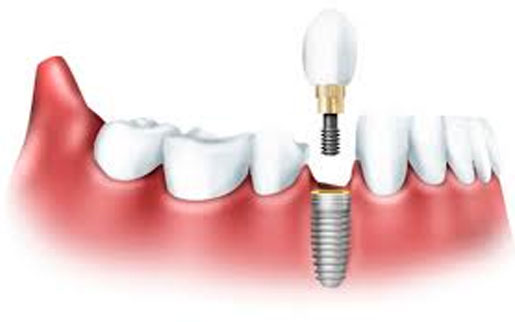 How many years can implant teeth last? What should we pay at