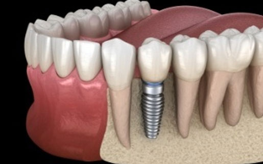 How to clean the dental implant teeth?