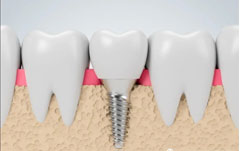 <b>Still suffering from missing teeth? Try dental implants!</b>