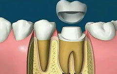 <b>What is root canal treatment?</b>