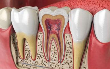 <b>How is root canal therapy performed?</b>