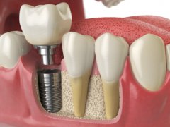 The whole process of dental implant